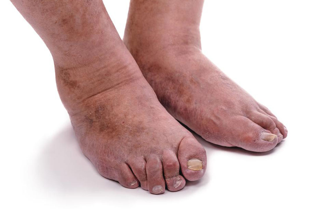 4 important things you need to know about rheumatoid arthritis